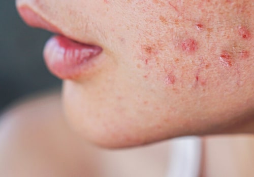 Polycystic Ovary Syndrome and Acne: What You Need to Know