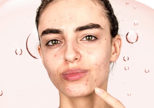 Serums and Oils for Acne Scars: What to Know